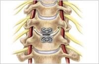 cervical disc spinal surgery