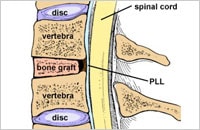 cervical discectomy surgery