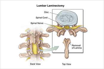 decompression lumbar