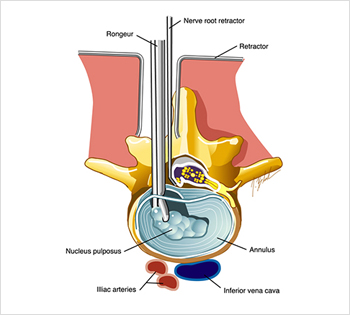 decompression surgery