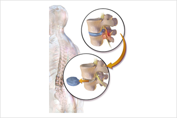 discectomy surgery