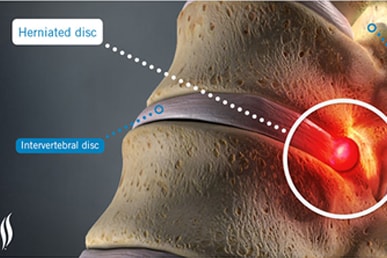 hernated disk