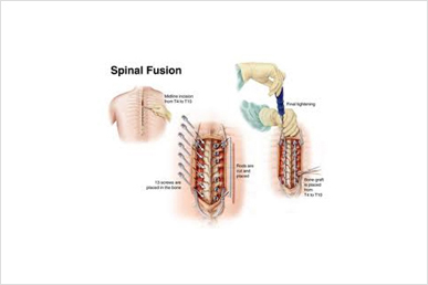 hernated spinal fusion