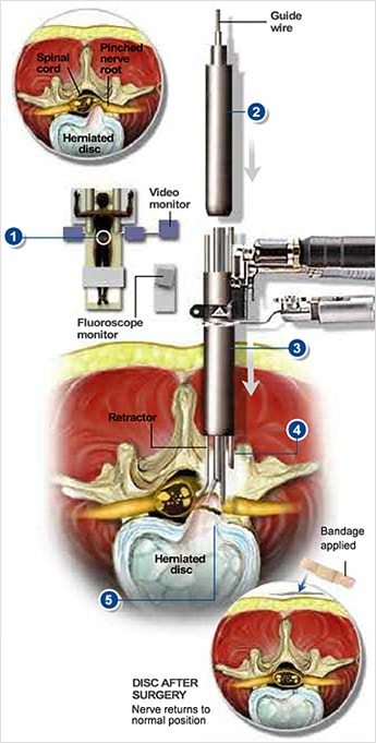 micro endoscopic discectomy