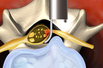 micro endoscopic