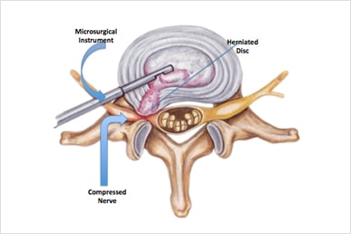 microdiskectomy hernated