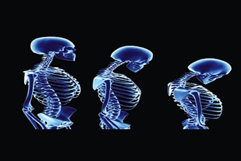 osteoporosis and spine fracture