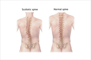 scoliosis conditions