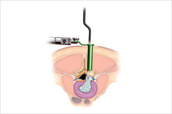 slipped disc treatment