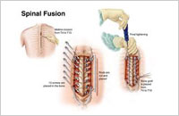 spinal fusion surgery