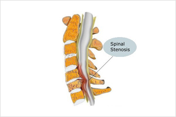 spinal stenosis