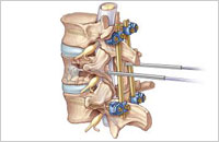 spine decompression surgery