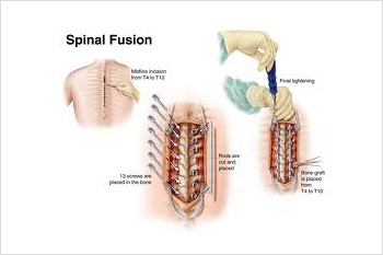 spine fusion surgery