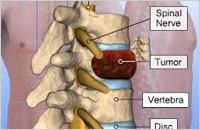 spine tumor surgery package