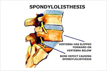 spondylolisthesis