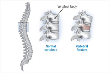 vertebral compression fractures